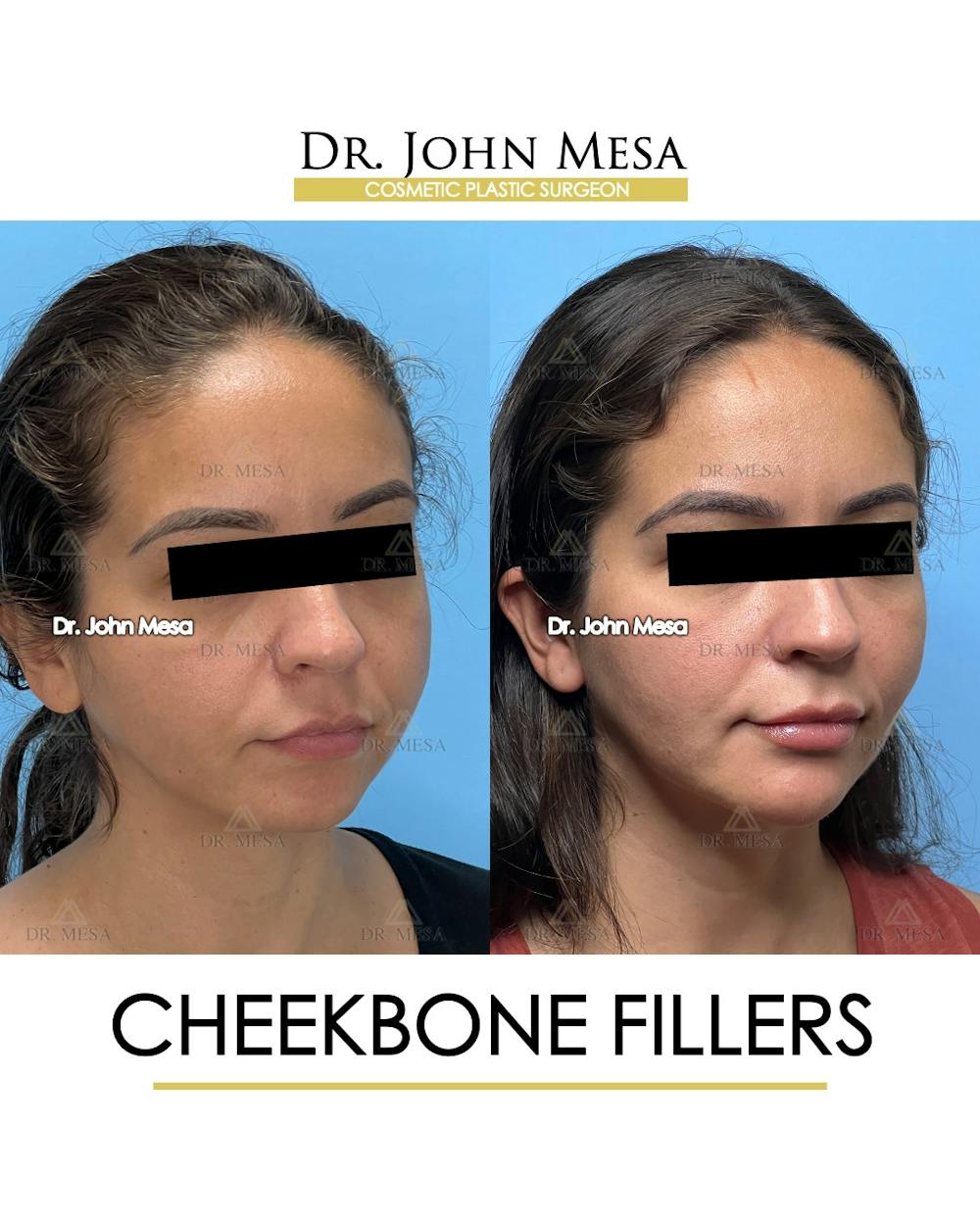 Cheekbone Filler Before & After Gallery - Patient 721648 - Image 3