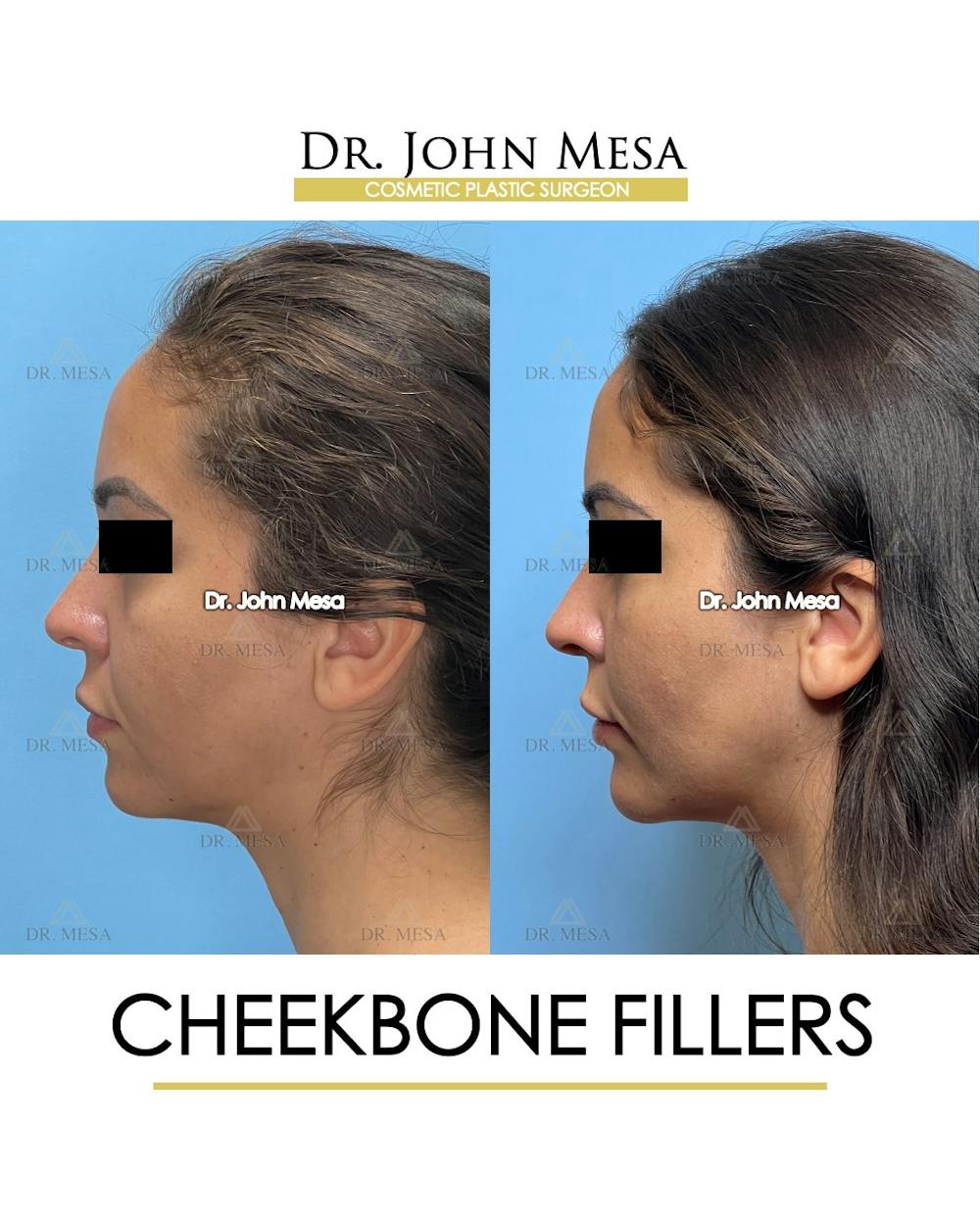 Cheekbone Filler Before & After Gallery - Patient 721648 - Image 6