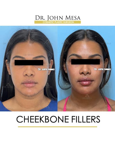 Cheekbone Filler Before & After Gallery - Patient 171036 - Image 1