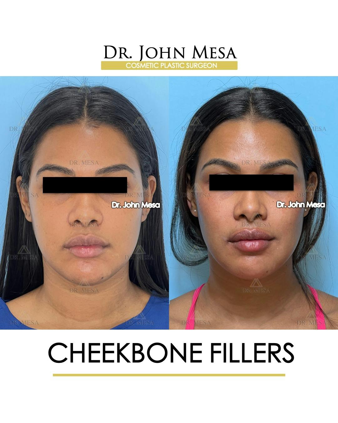 Cheekbone Filler Before & After Gallery - Patient 171036 - Image 1