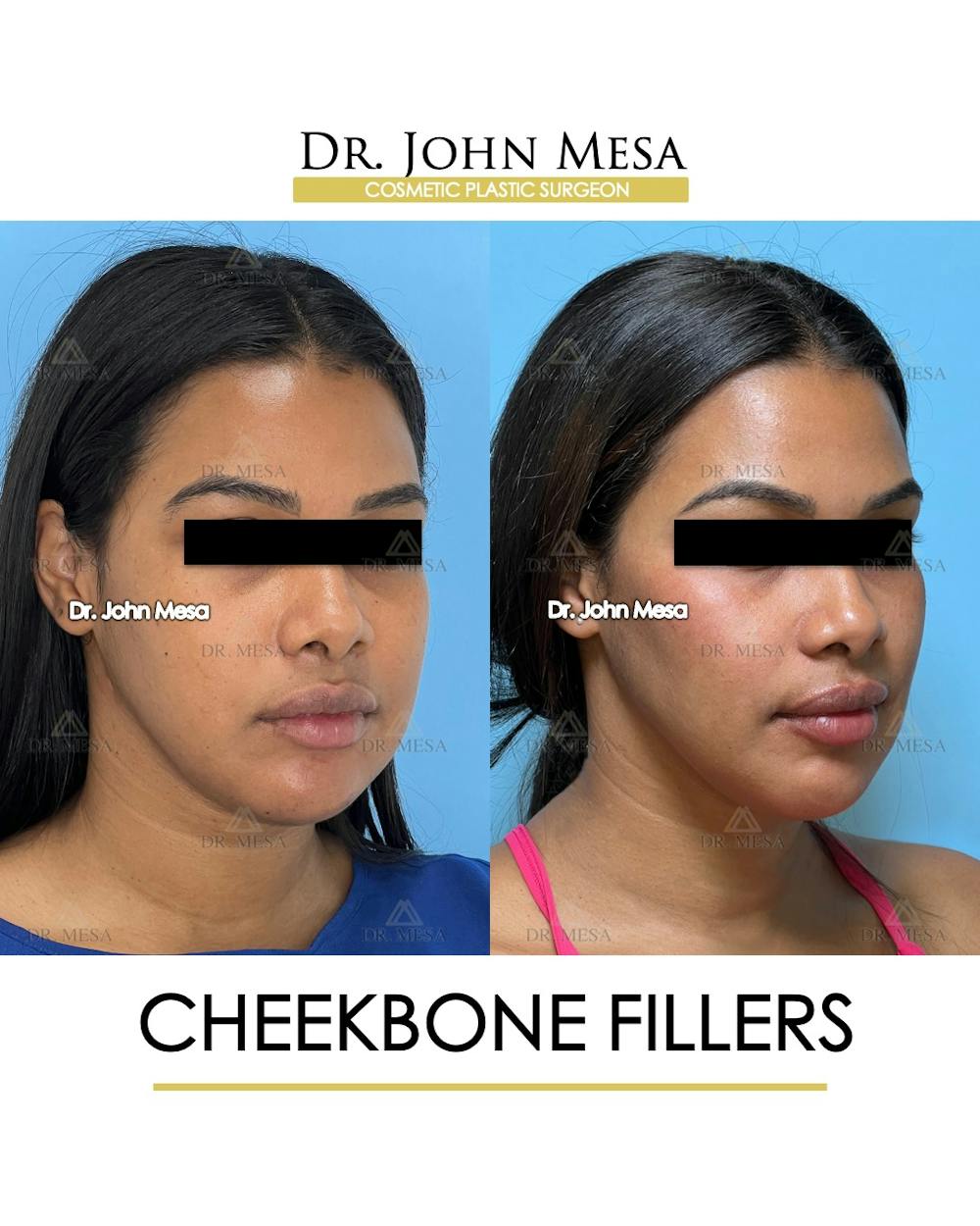 Cheekbone Filler Before & After Gallery - Patient 171036 - Image 2