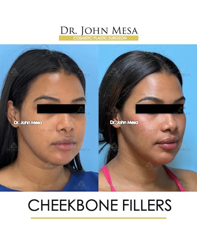 Cheekbone Filler Before & After Gallery - Patient 171036 - Image 2