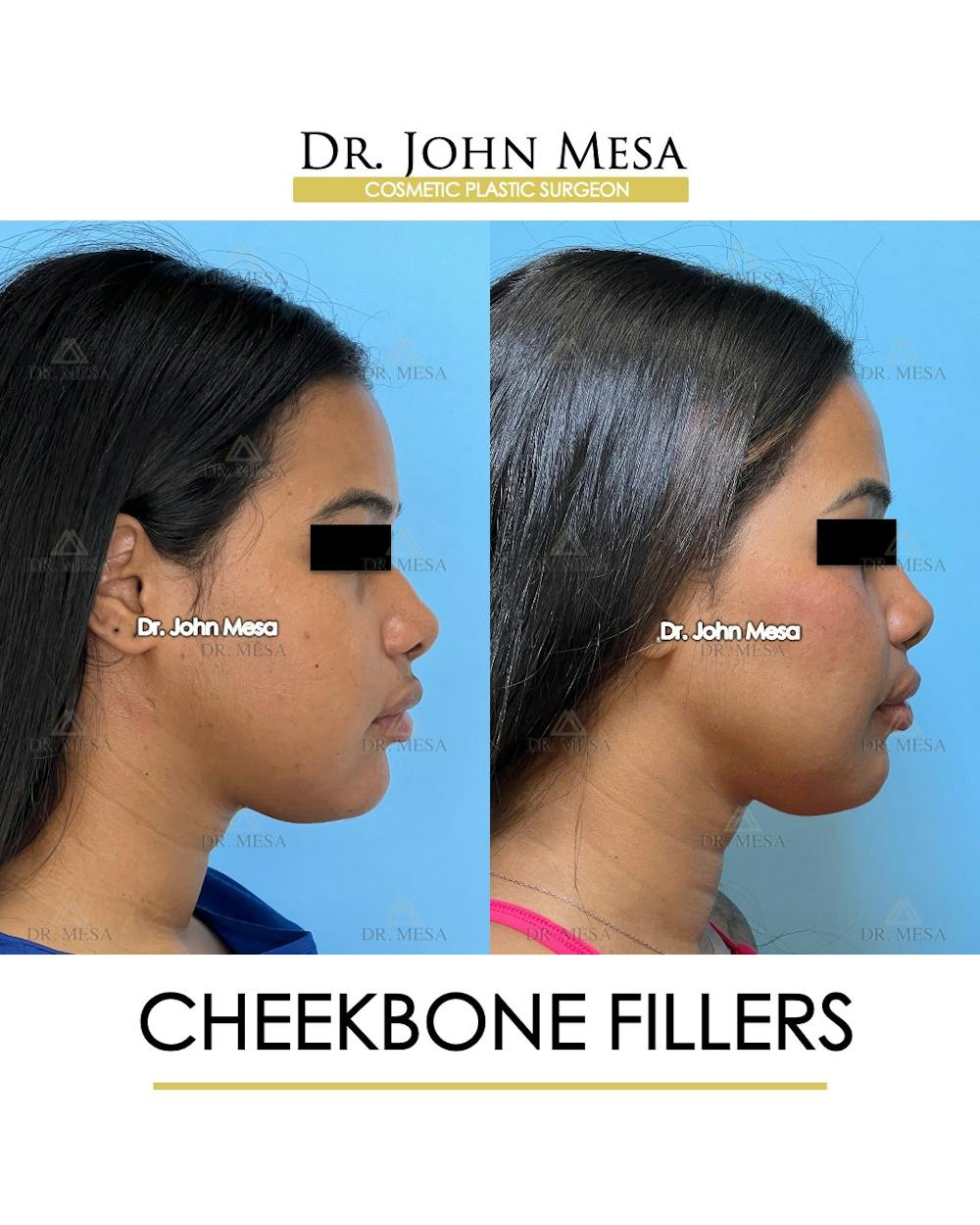 Cheekbone Filler Before & After Gallery - Patient 171036 - Image 3