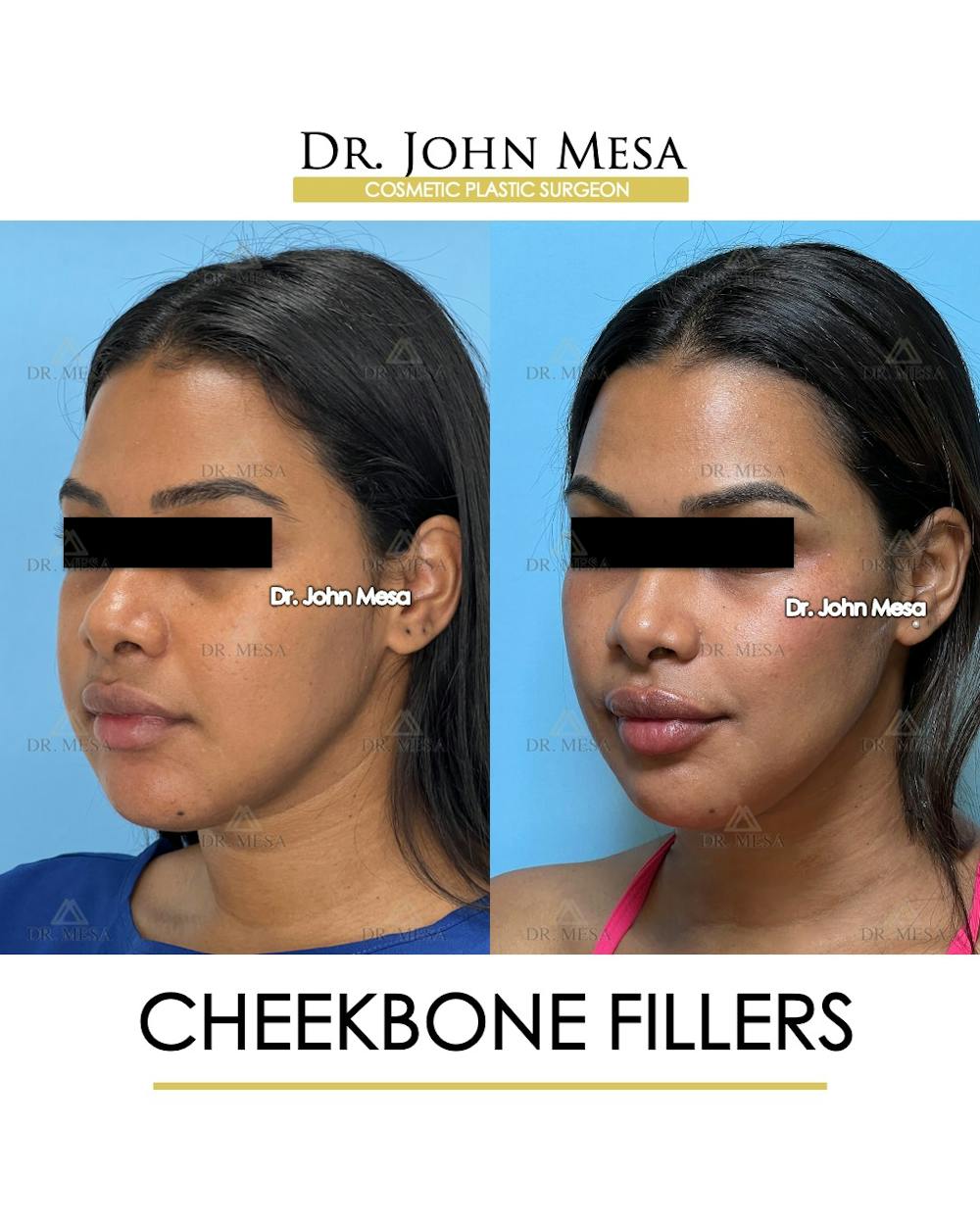 Cheekbone Filler Before & After Gallery - Patient 171036 - Image 4