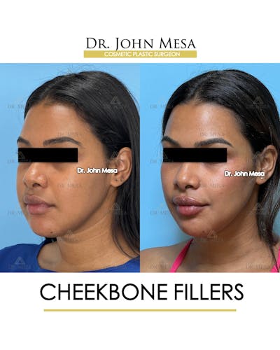 Cheekbone Filler Before & After Gallery - Patient 171036 - Image 4