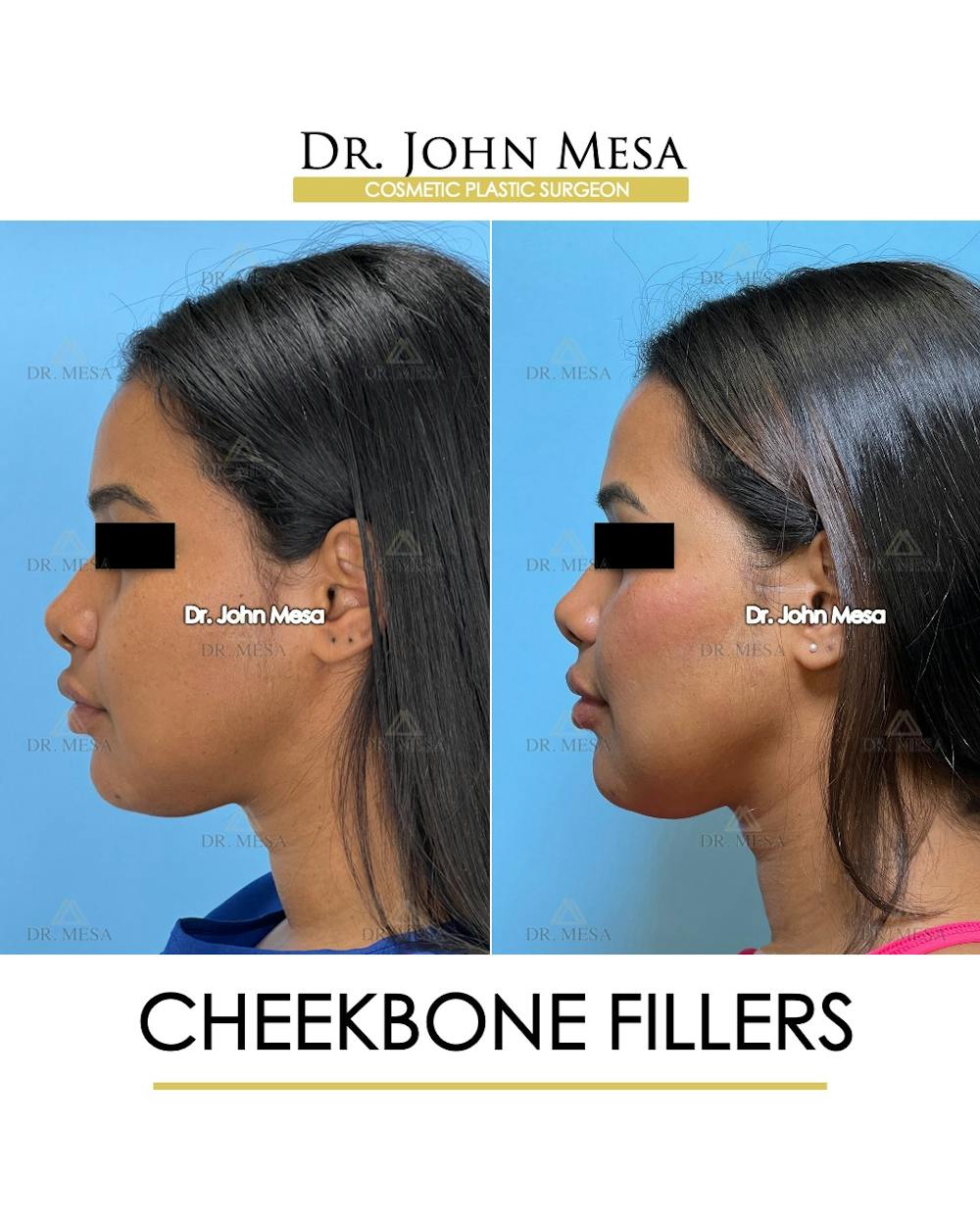 Cheekbone Filler Before & After Gallery - Patient 171036 - Image 5