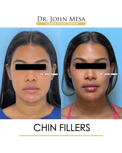 Chin Filler Before & After Gallery - Patient 400691 - Image 1