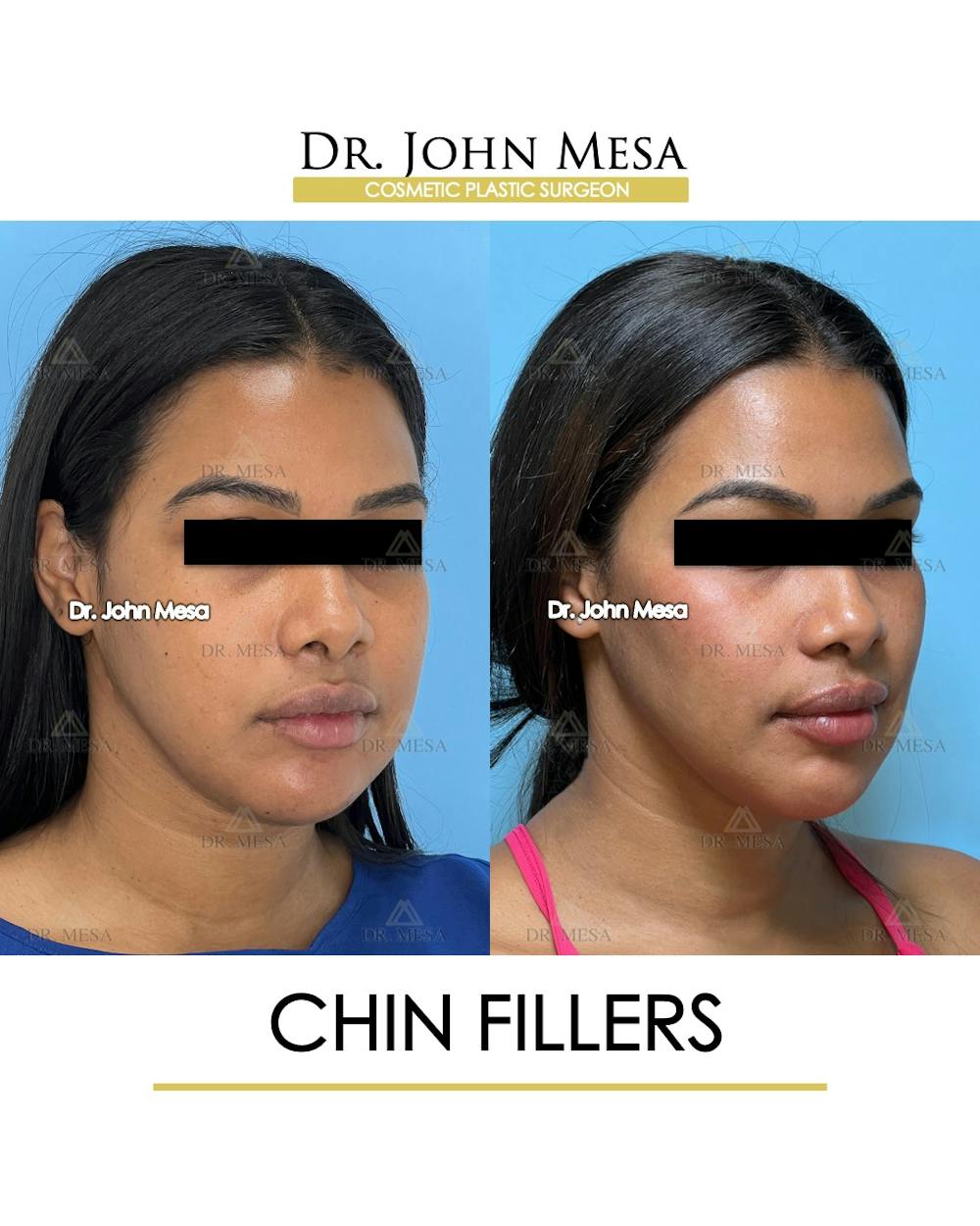 Chin Filler Before & After Gallery - Patient 400691 - Image 2