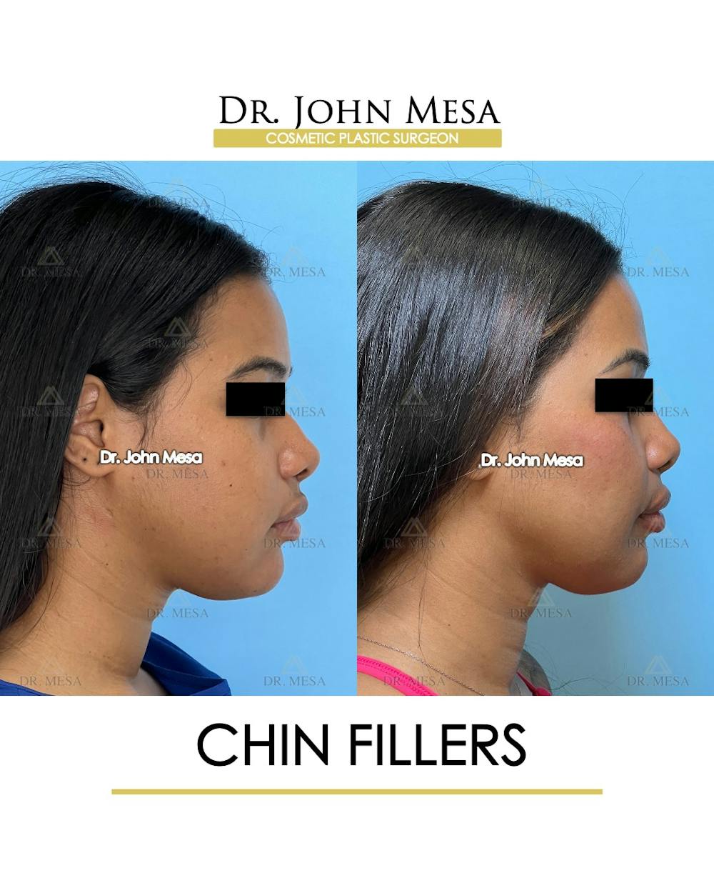 Chin Filler Before & After Gallery - Patient 400691 - Image 3