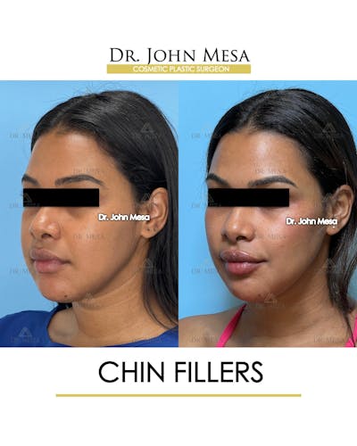 Chin Filler Before & After Gallery - Patient 400691 - Image 4