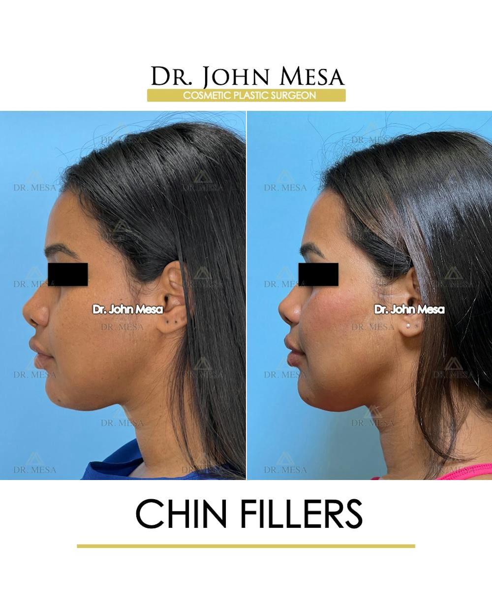 Chin Filler Before & After Gallery - Patient 400691 - Image 5