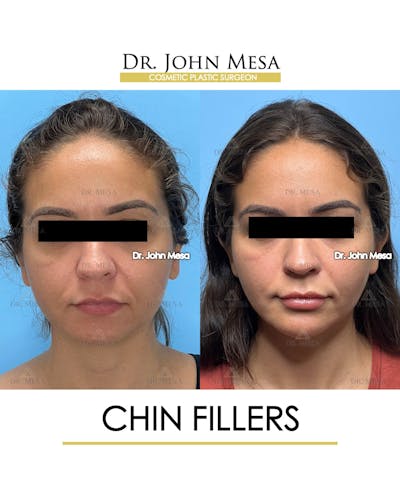 Chin Filler Before & After Gallery - Patient 129694 - Image 1