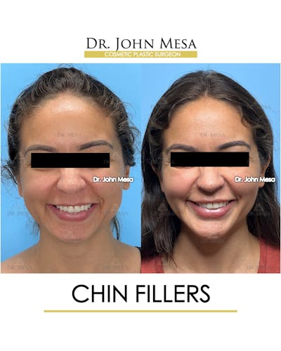 Chin Filler Before & After Gallery - Patient 129694 - Image 2