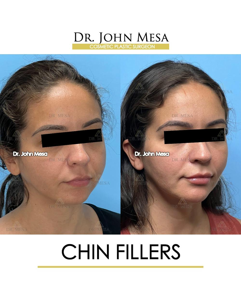 Chin Filler Before & After Gallery - Patient 129694 - Image 3