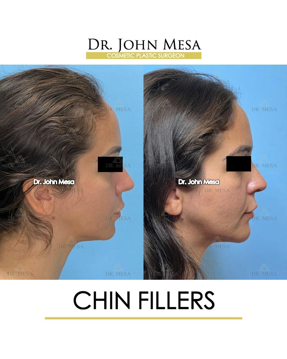 Chin Filler Before & After Gallery - Patient 129694 - Image 4