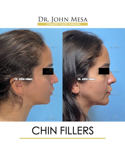 Chin Filler Before & After Gallery - Patient 129694 - Image 4