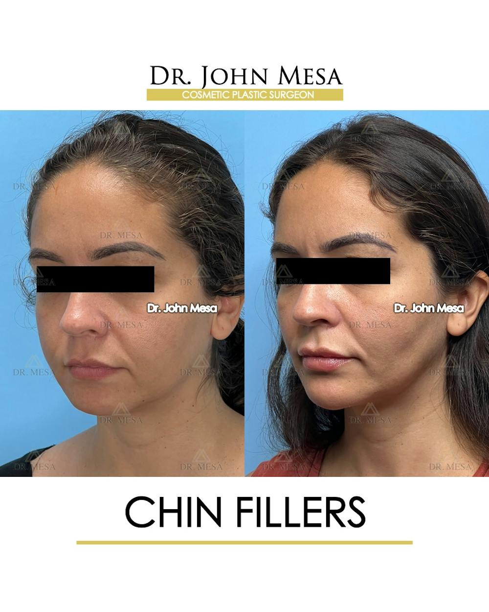 Chin Filler Before & After Gallery - Patient 129694 - Image 5