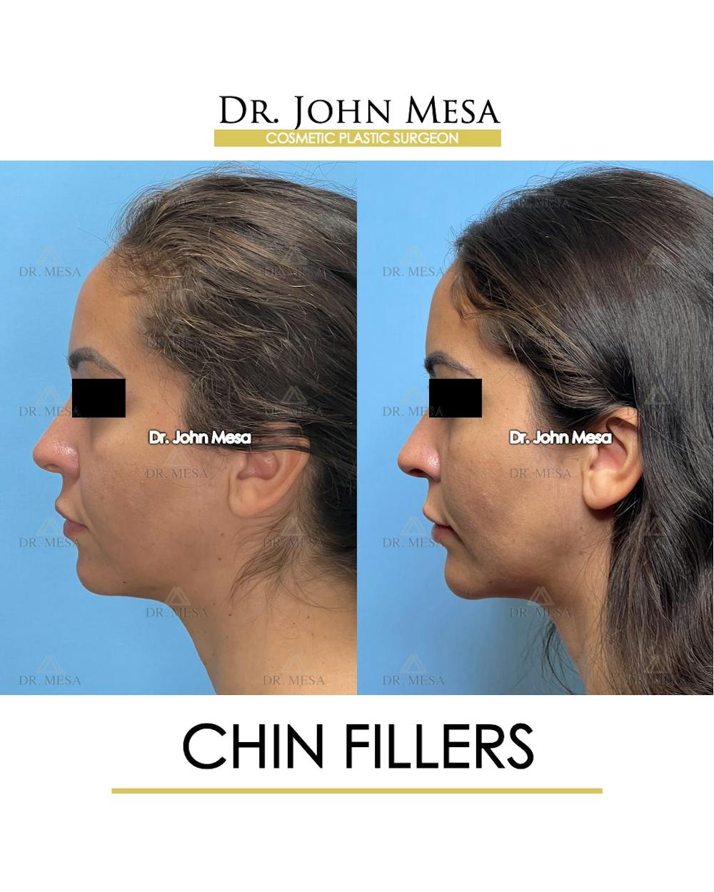 Chin Filler Before & After Gallery - Patient 129694 - Image 6