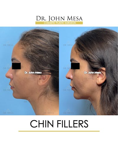 Chin Filler Before & After Gallery - Patient 129694 - Image 6