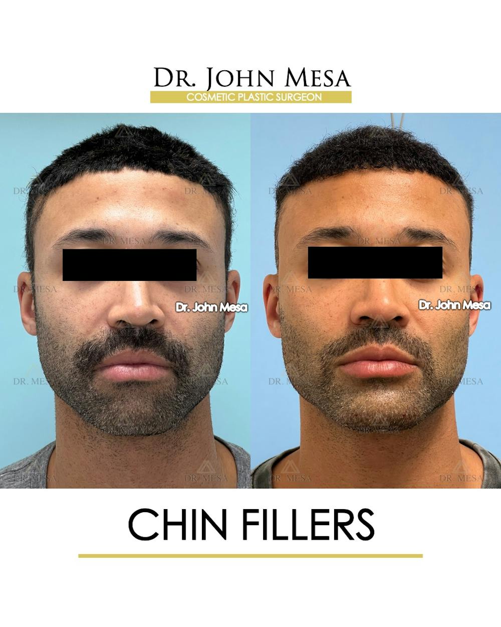 Chin Filler Before & After Gallery - Patient 131382 - Image 1