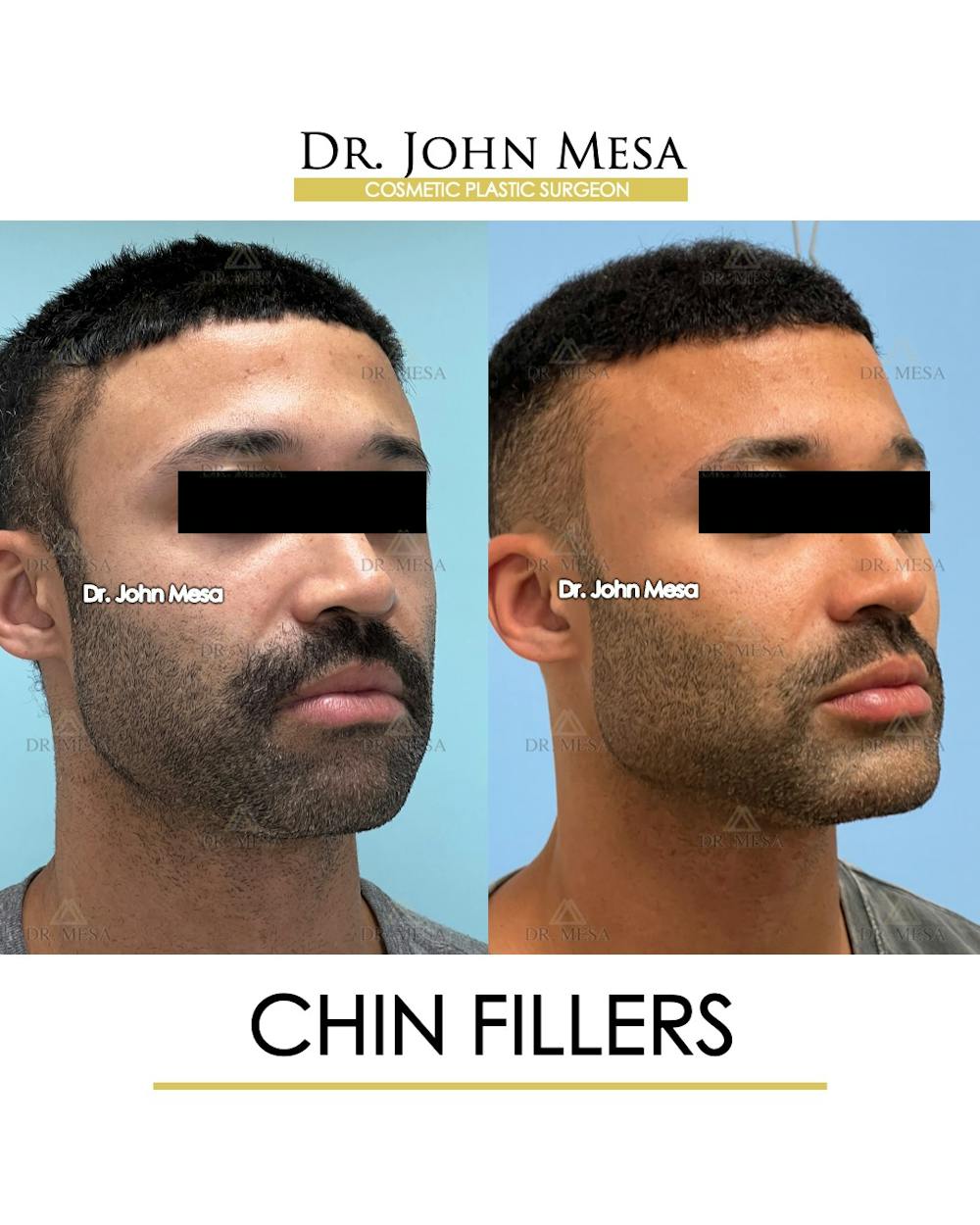 Chin Filler Before & After Gallery - Patient 131382 - Image 2