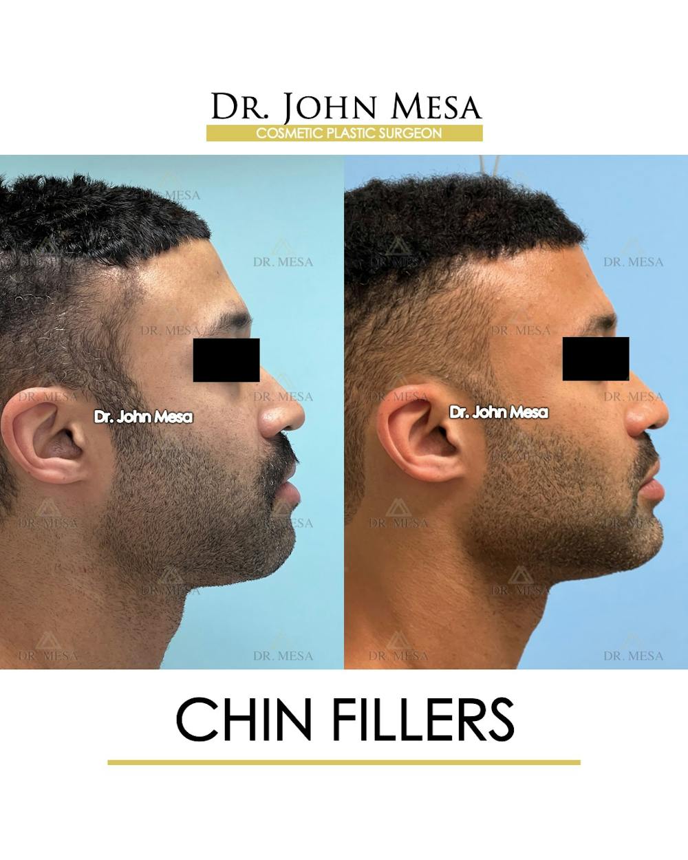 Chin Filler Before & After Gallery - Patient 131382 - Image 3