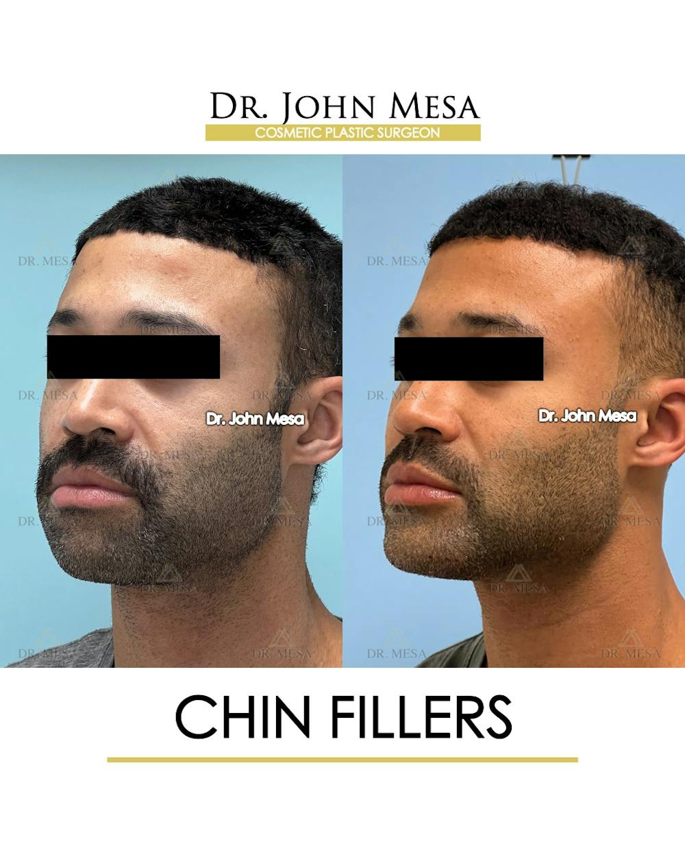 Chin Filler Before & After Gallery - Patient 131382 - Image 4