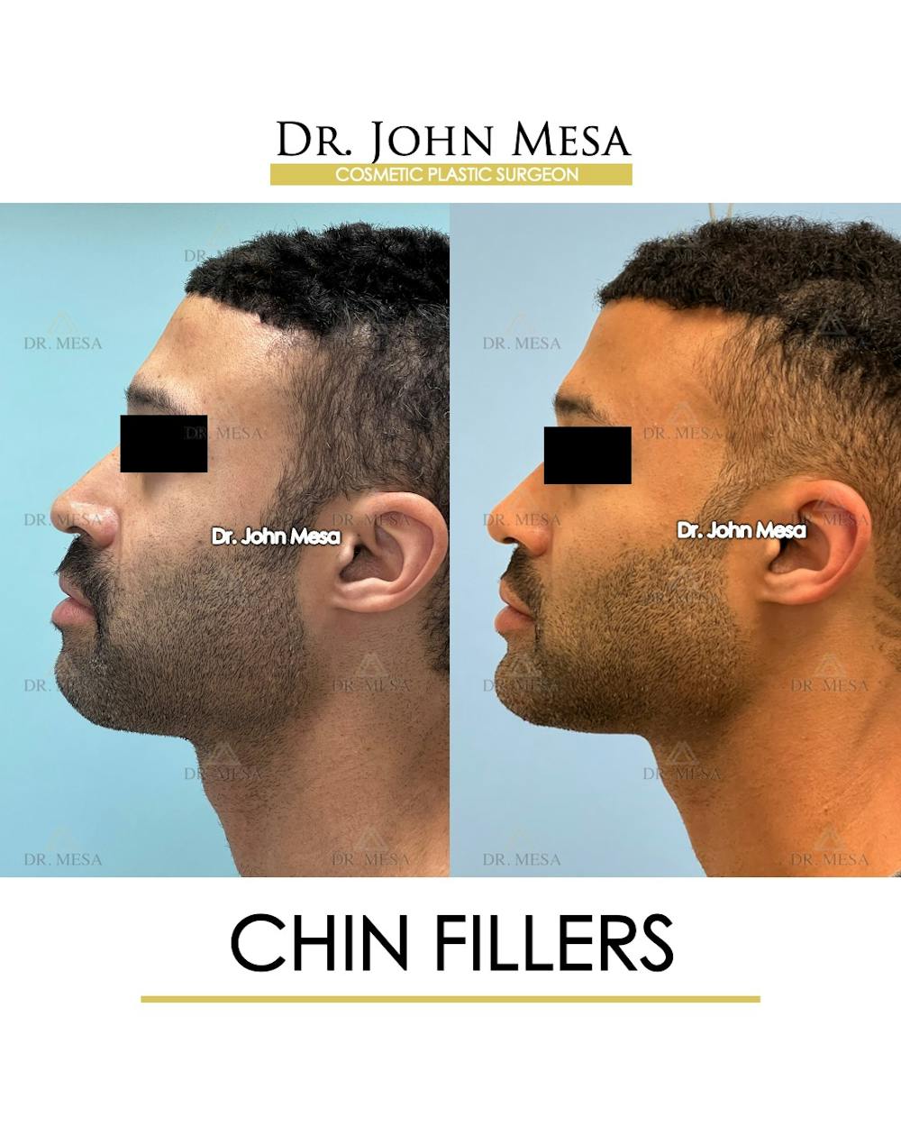 Chin Filler Before & After Gallery - Patient 131382 - Image 5