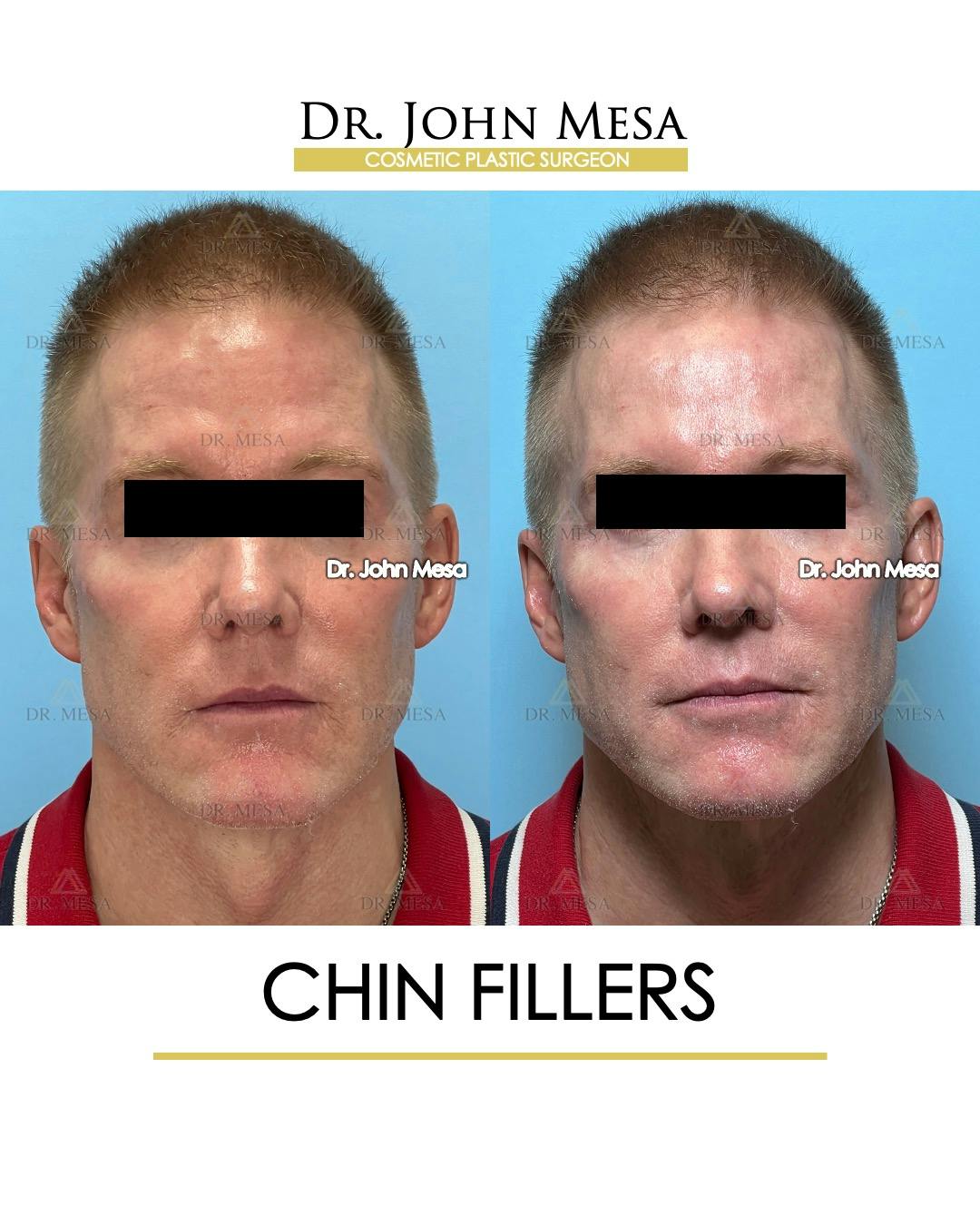 Chin Filler Before & After Gallery - Patient 341137 - Image 1