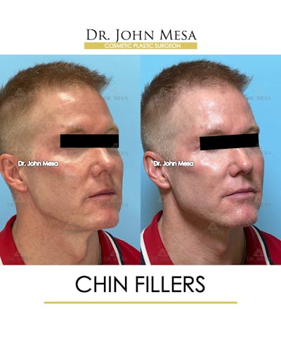 Chin Filler Before & After Gallery - Patient 341137 - Image 2
