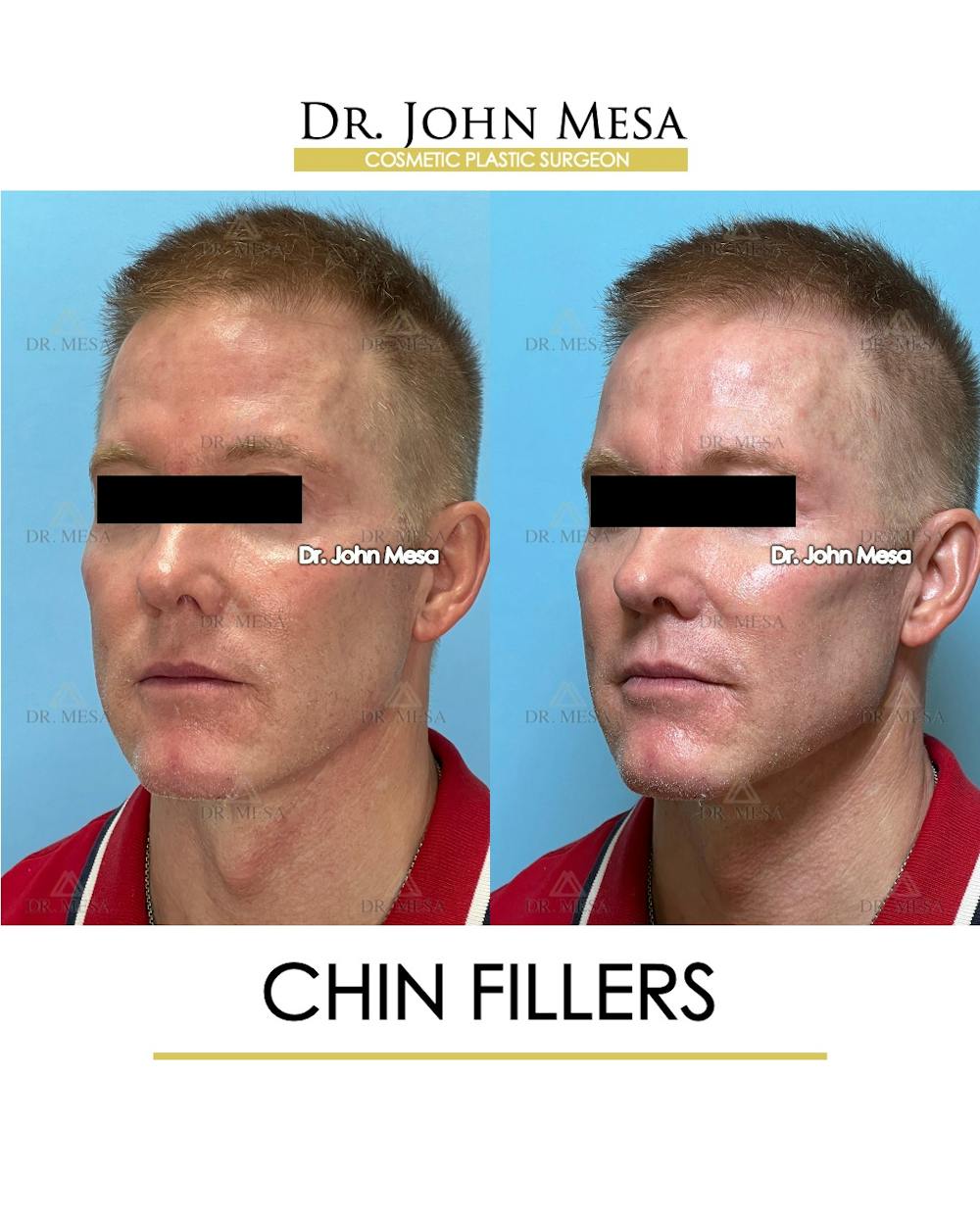 Chin Filler Before & After Gallery - Patient 341137 - Image 3