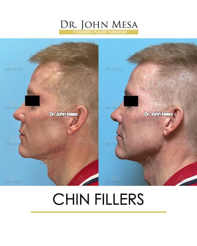 Chin Filler Before & After Gallery - Patient 341137 - Image 4
