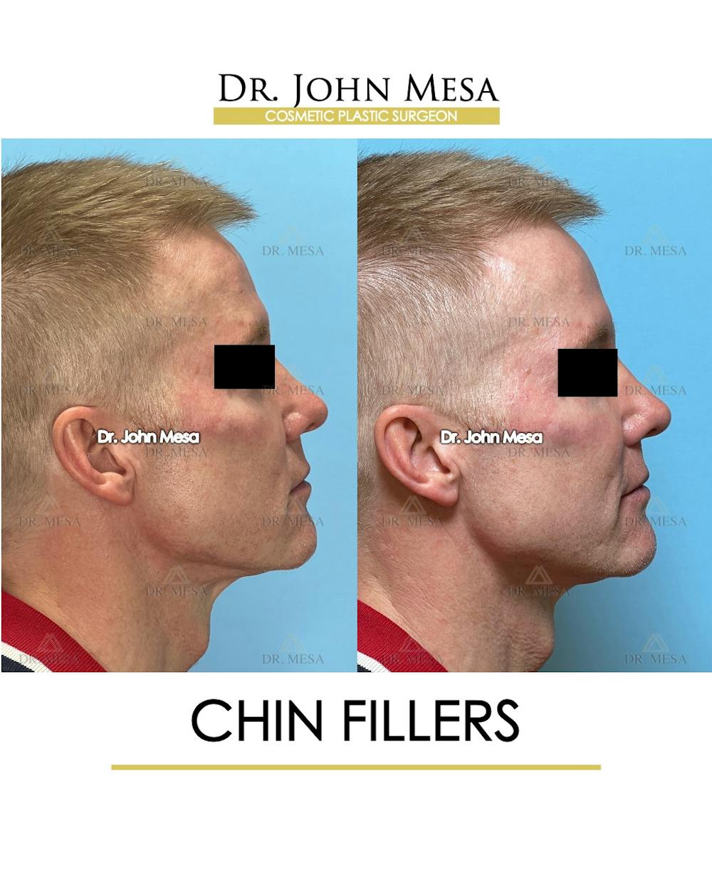 Chin Filler Before & After Gallery - Patient 341137 - Image 5