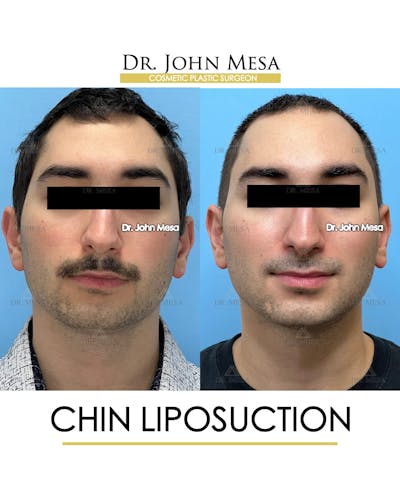 Chin Liposuction Before & After Gallery - Patient 141644 - Image 2