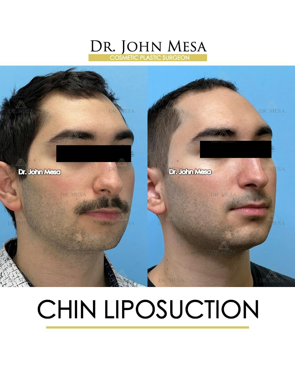 Chin Liposuction Before & After Gallery - Patient 141644 - Image 3
