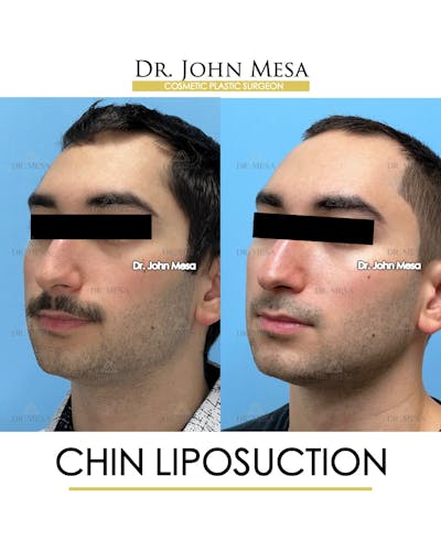 Chin Liposuction Before & After Gallery - Patient 141644 - Image 4