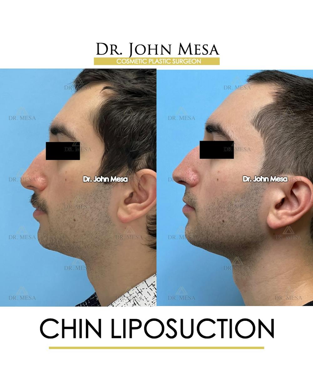 Chin Liposuction Before & After Gallery - Patient 141644 - Image 5