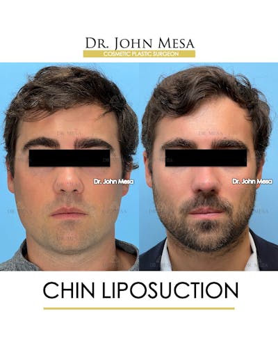 Chin Liposuction Before & After Gallery - Patient 747464 - Image 2