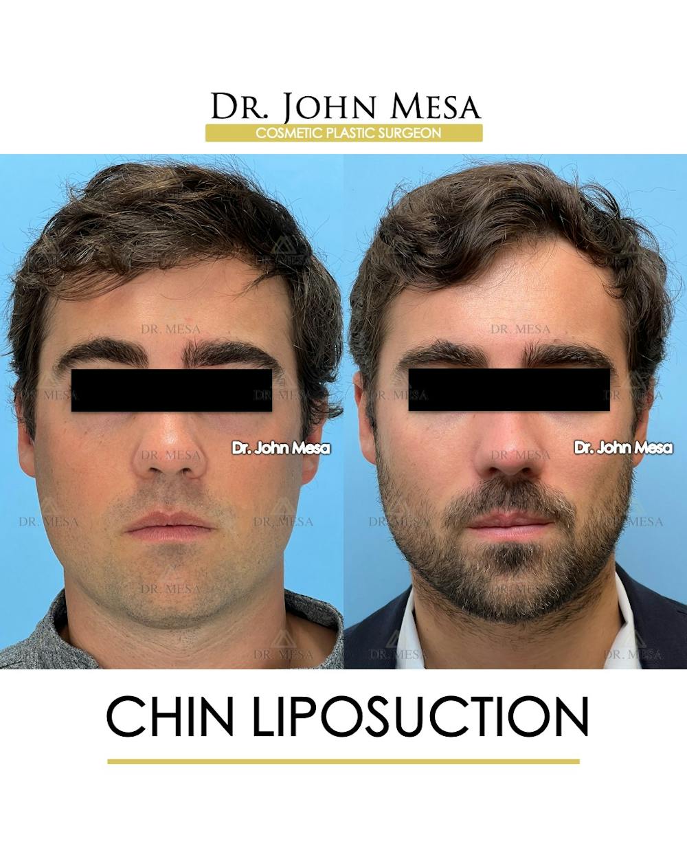 Chin Liposuction Before & After Gallery - Patient 747464 - Image 1