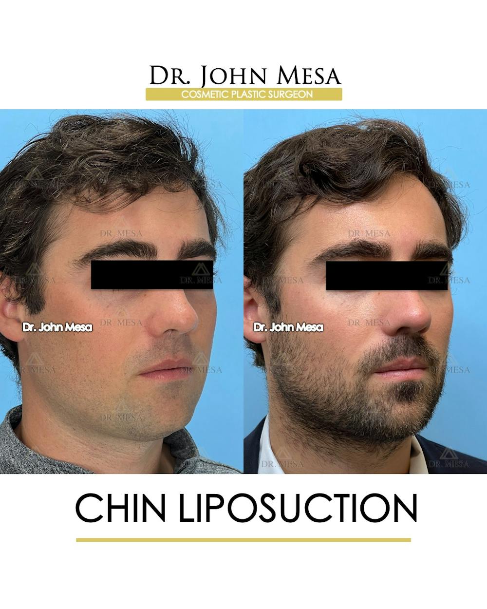 Chin Liposuction Before & After Gallery - Patient 747464 - Image 3