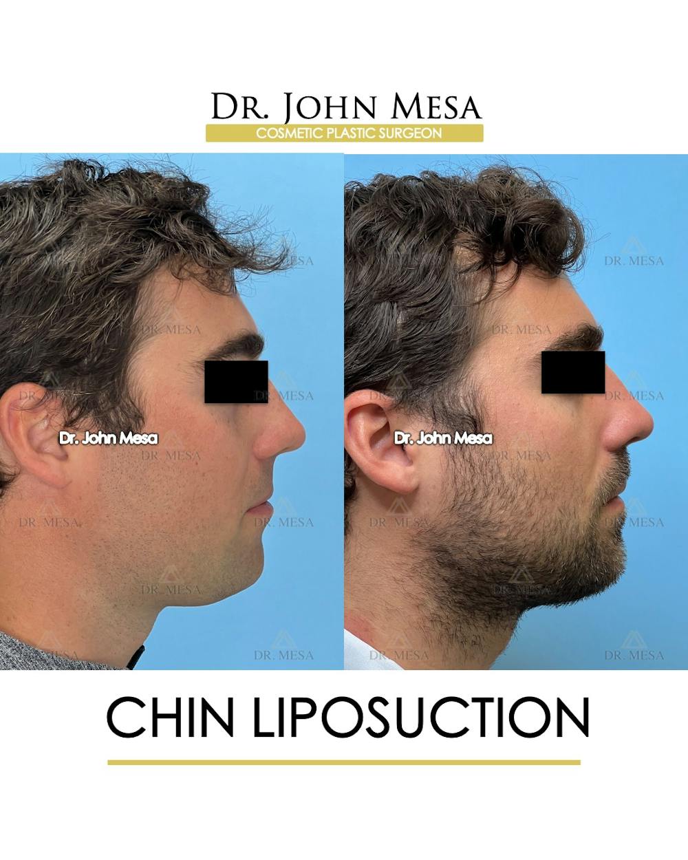 Chin Liposuction Before & After Gallery - Patient 747464 - Image 1