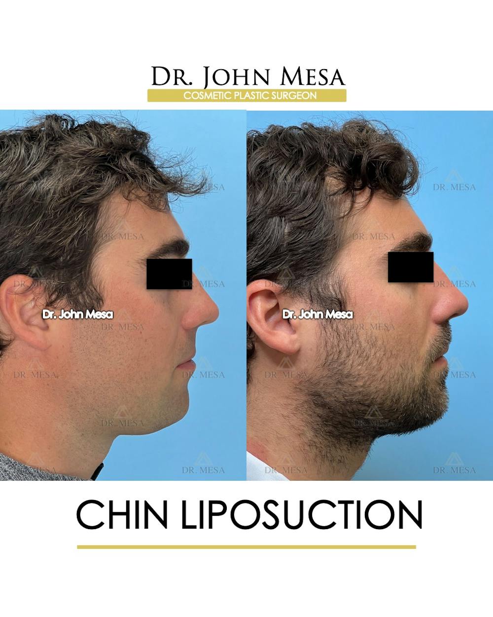 Chin Liposuction Before & After Gallery - Patient 747464 - Image 3