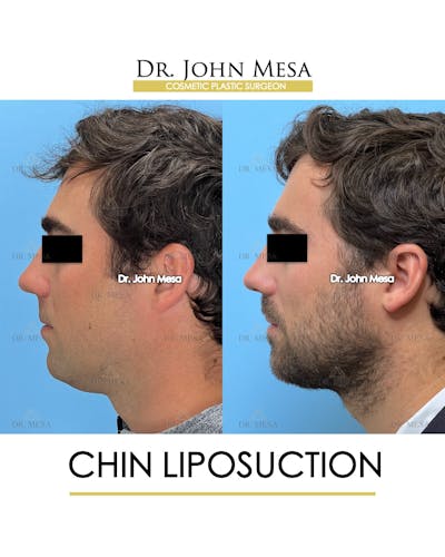 Chin Liposuction Before & After Gallery - Patient 747464 - Image 4