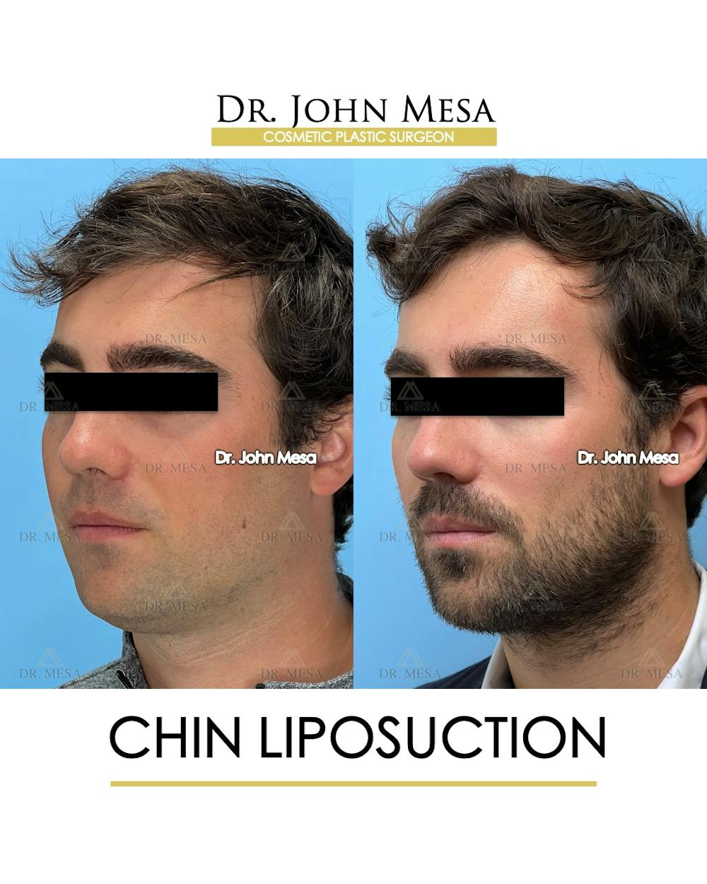 Chin Liposuction Before & After Gallery - Patient 747464 - Image 5