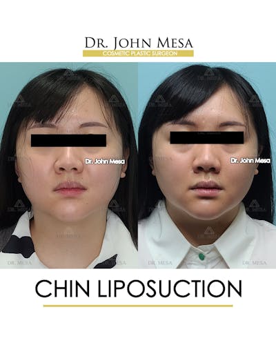 Chin Liposuction Before & After Gallery - Patient 287490 - Image 2
