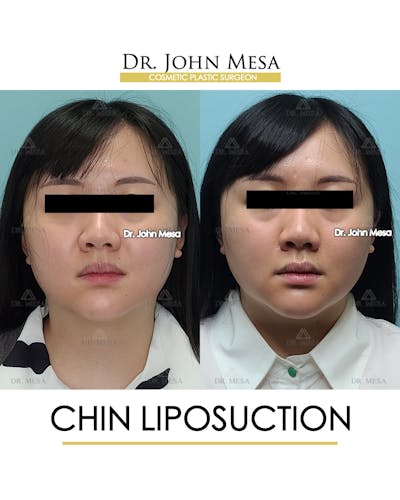 Chin Liposuction Before & After Gallery - Patient 287490 - Image 1
