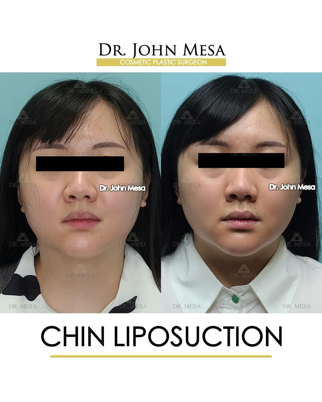 Chin Liposuction Before & After Gallery - Patient 287490 - Image 1