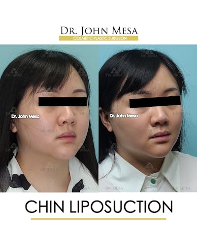 Chin Liposuction Before & After Gallery - Patient 287490 - Image 2