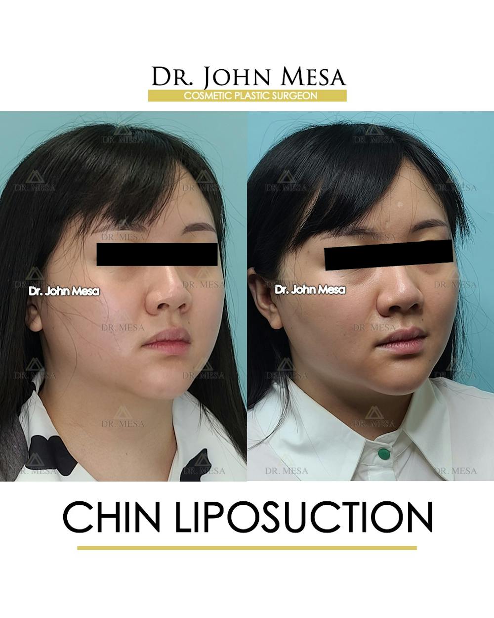 Chin Liposuction Before & After Gallery - Patient 287490 - Image 2