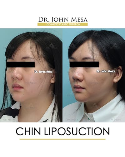 Chin Liposuction Before & After Gallery - Patient 287490 - Image 4